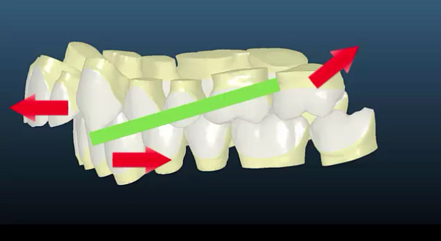 le Set Up virtuel dynamique en Orthodontie