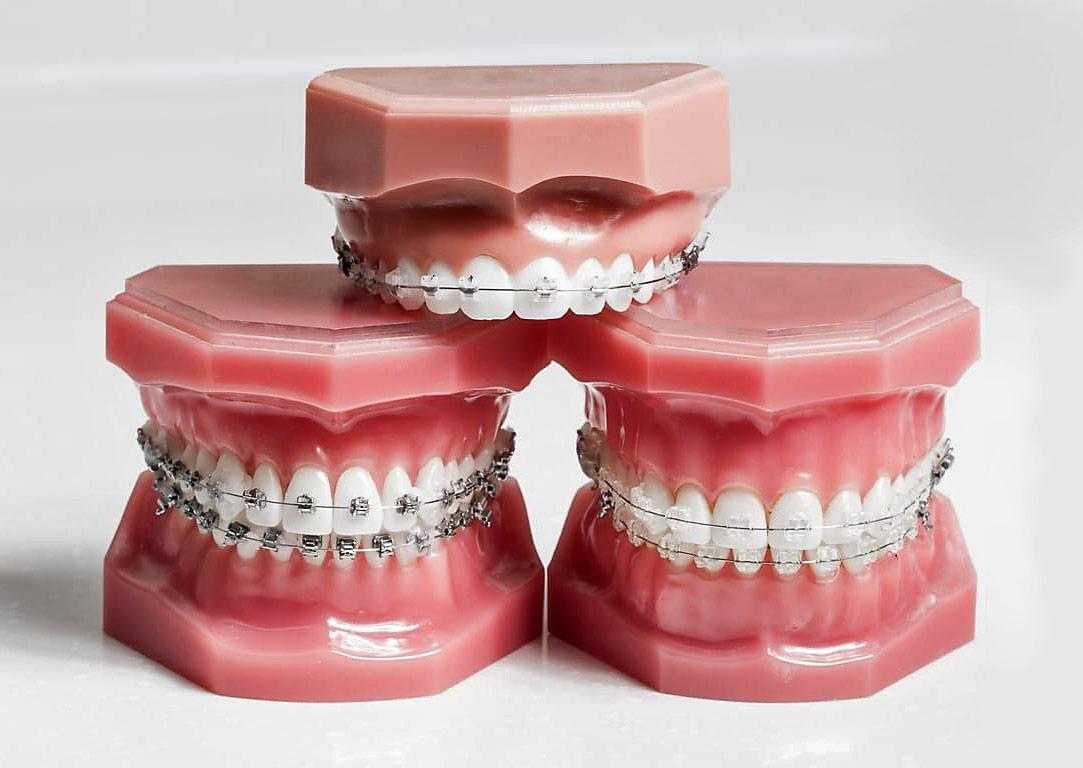 Les appareils en orthodontie